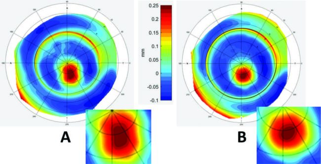 Collagen Crosslinking (CXL) Can Change Scleral Shape Featured Image