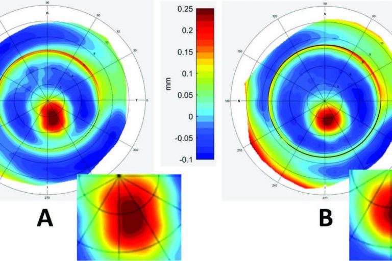 Collagen Crosslinking (CXL) Can Change Scleral Shape Featured Image