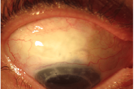 A patients eye demonstrating previous corneal transplant and the supero-temporal filtering bleb, Visionary Optics