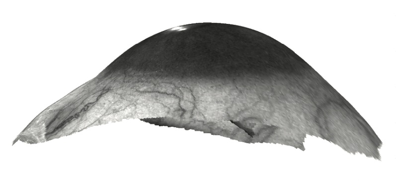 Scleral Lens Decentration figure 1