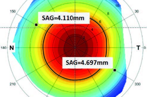 Scleral Lens Decentration figure 2