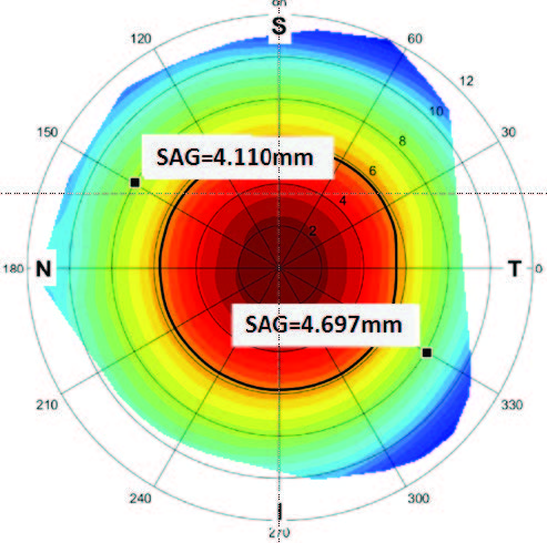 Scleral Lens Decentration figure 2