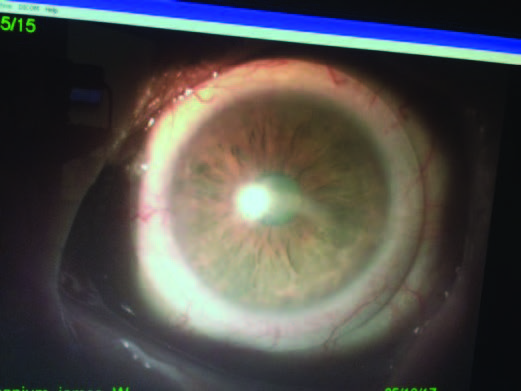 Scleral Lens Decentration figure 5