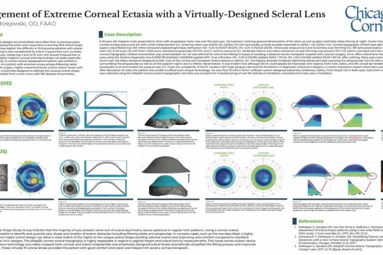 Virtually-Designed Scleral Lens
