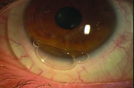 A patient's eye displaying an inferior scleral lens fit