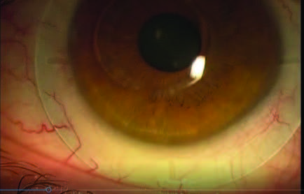 A patient with a successful scleral lens fit, Visionary Optics