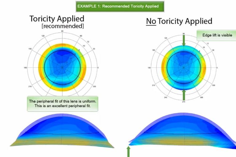 video-thumbnail-enhanced-scleral-toricity