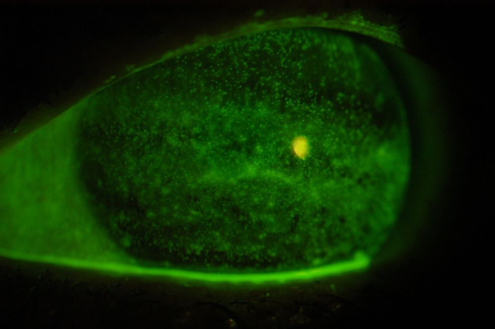 Figure 1: severe keratoconjunctivitis in graft versus host disease