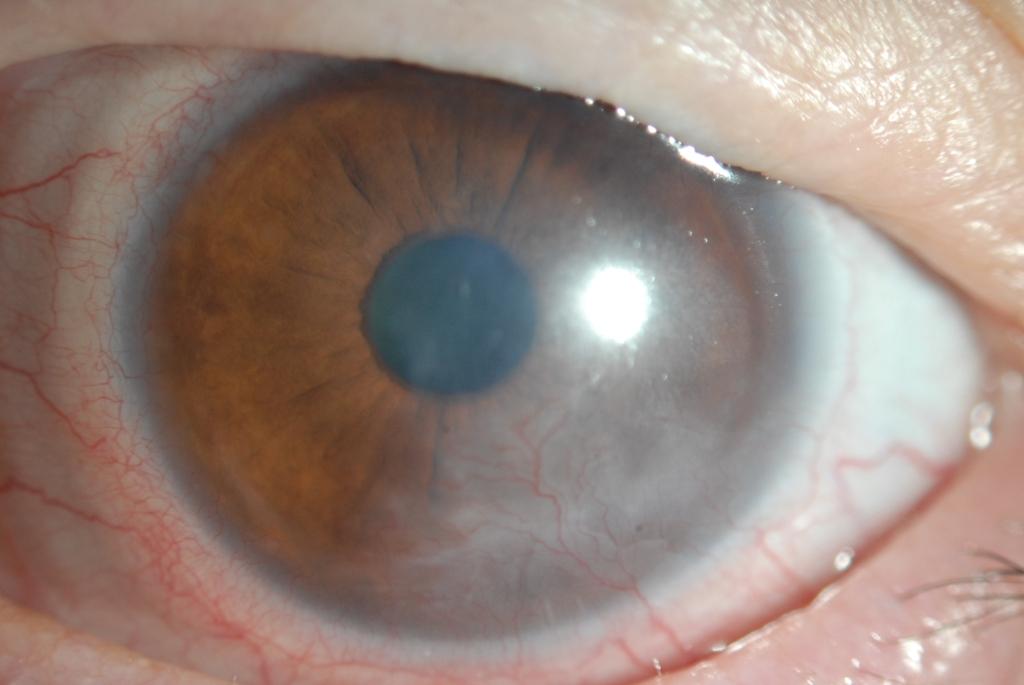 Figure 2: Corneal Pannus in Stevens-Johnson syndrome