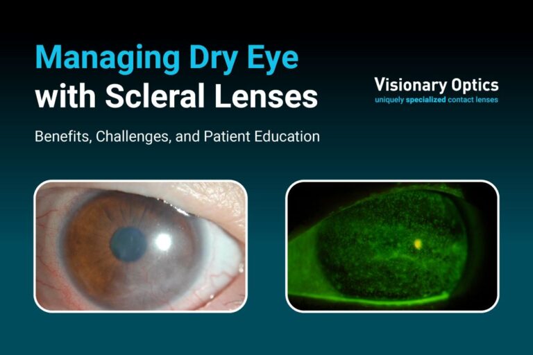 Managing Dry Eye with Scleral Lenses Benefits, Challenges, and Patient Education