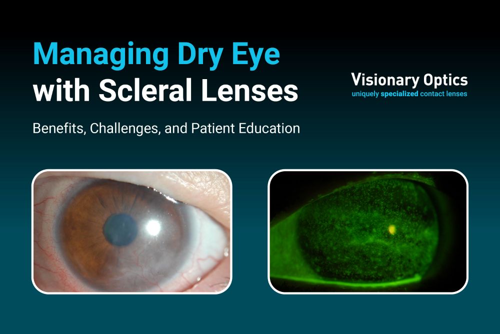 Managing Dry Eye with Scleral Lenses Benefits, Challenges, and Patient Education